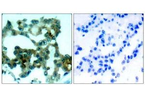 Immunohistochemical analysis of paraffin-embedded human lung carcinoma tissue, using PKCβ (Ab-641) antibody (E021184).