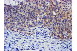 Immunohistochemical staining of paraffin-embedded Adenocarcinoma of Human ovary tissue using anti-PLDN mouse monoclonal antibody. (Pallidin antibody)