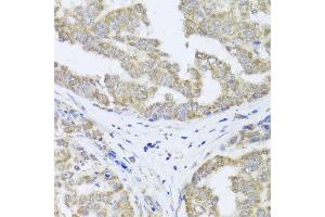 Immunohistochemistry of paraffin-embedded human liver cancer using TIMM10B antibody at dilution of 1:100 (x40 lens).