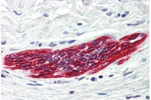 Human Breast (formalin-fixed, paraffin-embedded) stained with DAPK2 antibody ABIN214481 at 5 ug/ml followed by biotinylated goat anti-rabbit IgG secondary antibody ABIN481713, alkaline phosphatase-streptavidin and chromogen. (DAPK2 antibody  (C-Term))