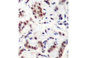 Immunohistochemistry (IHC) image for anti-Signal Transducer and Activator of Transcription 5A (STAT5A) (pTyr694) antibody (ABIN3019614) (STAT5A antibody  (pTyr694))
