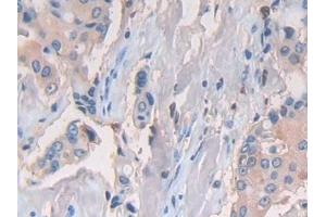 Detection of CD74 in Human Breast cancer Tissue using Polyclonal Antibody to Cluster Of Differentiation 74 (CD74) (CD74 antibody  (AA 78-222))