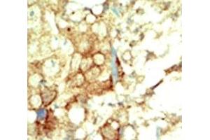 IHC analysis of FFPE human breast carcinoma tissue stained with the RET antibody (Ret Proto-Oncogene antibody  (AA 1012-1042))