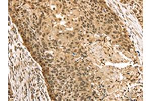 The image on the left is immunohistochemistry of paraffin-embedded Human esophagus cancer tissue using ABIN7131203(STAG2 Antibody) at dilution 1/35, on the right is treated with fusion protein. (STAG2 antibody)