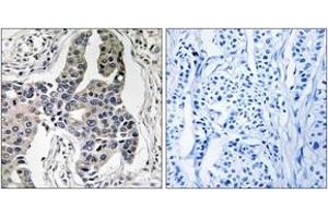 Immunohistochemistry analysis of paraffin-embedded human breast carcinoma, using Vimentin (Phospho-Ser83) Antibody. (Vimentin antibody  (pSer83))