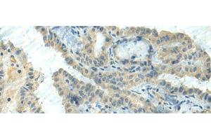 Immunohistochemistry of paraffin-embedded Human thyroid cancer tissue using CTDP1 Polyclonal Antibody at dilution of 1:55(x200) (CTDP1 antibody)