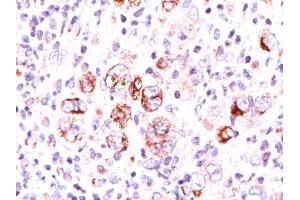 Formalin-fixed, paraffin-embedded Hodgkin's lymphoma stained with Bcl-x Mouse Monoclonal Antibody (2H12). (BCL2L1 antibody  (AA 3-14))
