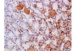 Formalin-fixed and paraffin embedded human gastric carcinoma labeled Anti-MAdCAM-1 Polyclonal Antibody, Unconjugated at 1:200, followed by conjugation to the secondary antibody and DAB staining
