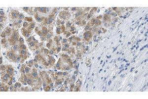 ABIN6269382 at 1/100 staining Human liver cancer tissue by IHC-P. (B-Cell Linker antibody  (N-Term))