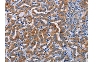 The image on the left is immunohistochemistry of paraffin-embedded Human thyroid cancer tissue using ABIN7128355(ALG12 Antibody) at dilution 1/20, on the right is treated with fusion protein.