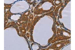 The image on the left is immunohistochemistry of paraffin-embedded Human thyroid cancer tissue using ABIN7130584(PEF1 Antibody) at dilution 1/20, on the right is treated with fusion protein. (PEF1 antibody)