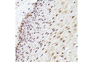 Immunohistochemistry of paraffin-embedded human esophageal using MLF2 antibody (ABIN7268725) at dilution of 1:100 (40x lens). (MLF2 antibody  (AA 1-65))