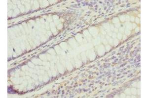 Immunohistochemistry of paraffin-embedded human colon cancer using ABIN7142221 at dilution of 1:100 (PSMD8 antibody  (Regulatory Subunit 8))