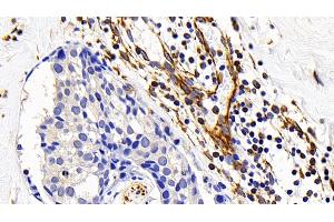 Detection of FAS in Human Breast cancer Tissue using Polyclonal Antibody to Factor Related Apoptosis (FAS) (FAS antibody)