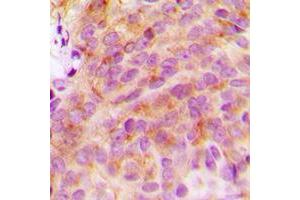 Immunohistochemical analysis of 14-3-3 zeta staining in human breast cancer formalin fixed paraffin embedded tissue section. (14-3-3 zeta antibody  (C-Term))