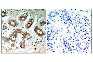 Immunohistochemical analysis of paraffin-embedded human breast carcinoma tissue using 14-3-3z(Phospho-Ser58) Antibody(left) or the same antibody preincubated with blocking peptide(right). (14-3-3 zeta antibody  (pSer58))