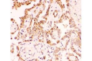 IHC-P: SIRT2 antibody testing of human lung cancer tissue (SIRT2 antibody  (AA 165-187))