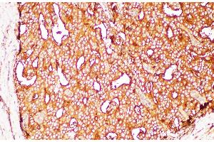 Immunohistochemistry of paraffin-embedded Human prostate cancer using FOLH1 Polycloanl Antibody at dilution of 1:200 (PSMA antibody)