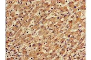 Immunohistochemistry of paraffin-embedded human liver cancer using ABIN7150673 at dilution of 1:100 (TGDS antibody  (AA 143-305))