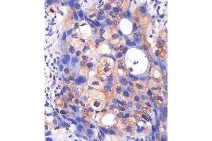 (ABIN6243071 and ABIN6577240) staining PK3/1 in hun breast carcino sections by Immunohistochemistry (IHC-P - paraforldehyde-fixed, paraffin-embedded sections). (ERK1 antibody  (AA 175-208))