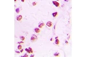 Immunohistochemical analysis of p300 staining in human lung cancer formalin fixed paraffin embedded tissue section. (p300 antibody  (N-Term))