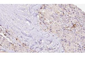 ABIN6273309 at 1/100 staining Human thyroid cancer tissue by IHC-P. (RIC8B antibody  (C-Term))