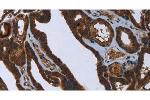 Immunohistochemistry of paraffin-embedded Human thyroid cancer using FASTKD2 Polyclonal Antibody at dilution of 1:45 (FASTKD2 antibody)