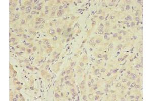 Immunohistochemistry of paraffin-embedded human liver cancer using ABIN7175887 at dilution of 1:100