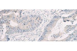 Immunohistochemistry of paraffin-embedded Human colorectal cancer tissue using WNK4 Polyclonal Antibody at dilution of 1:45(x200) (WNK4 antibody)