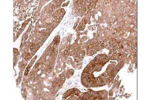 IHC-P Image Immunohistochemical analysis of paraffin-embedded gastric N87 xenograft, using ALDH1A1, antibody at 1:100 dilution. (ALDH1A1 antibody  (C-Term))
