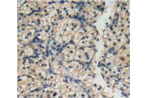 IHC-P analysis of kidney cancer tissue, with DAB staining.