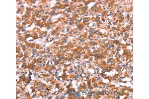 Immunohistochemistry of Human gastric cancer using GAS8 Polyclonal Antibody at dilution of 1:30
