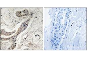Immunohistochemistry analysis of paraffin-embedded human breast carcinoma, using BCL-XL (Phospho-Thr115) Antibody. (BCL2L1 antibody  (pThr115))