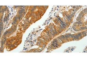 Immunohistochemistry of paraffin-embedded Human colon cancer using SH-PTP1 Polyclonal Antibody at dilution of 1:35 (SHP1 antibody)