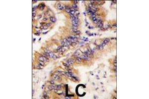 Formalin-fixed and paraffin-embedded human lung carcinoma tissue reacted with TRAPPC4 antibody , which was peroxidase-conjugated to the secondary antibody, followed by DAB staining.
