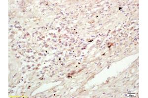 Formalin-fixed and paraffin embedded human lung carcinoma labeled with Rabbit Anti KIF11/Eg5/TRIP5 Polyclonal Antibody, Unconjugated (ABIN872373) at 1:200 followed by conjugation to the secondary antibody and DAB staining (K11 (AA 351-450) antibody)