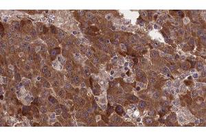 ABIN6277378 at 1/100 staining Human liver cancer tissue by IHC-P.