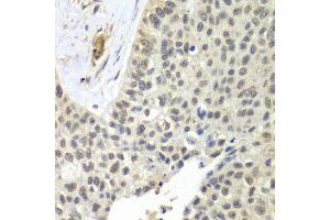 Immunohistochemistry of paraffin-embedded human lung cancer using SNRPD2 antibody at dilution of 1:100 (x40 lens). (SNRPD2 antibody)