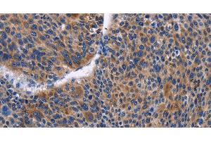 Immunohistochemistry of paraffin-embedded Human liver cancer tissue using IGSF10 Polyclonal Antibody at dilution 1:50