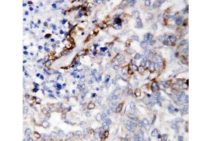 Anti-LAMC2 antibody, IHC(P): Human Lung Cancer Tissue