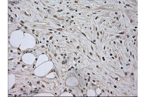Immunohistochemical staining of paraffin-embedded Carcinoma of kidney tissue using anti-SATB1mouse monoclonal antibody. (SATB1 antibody)