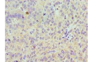 Immunohistochemistry of paraffin-embedded human liver cancer using ABIN7158607 at dilution of 1:100 (LYVE1 antibody  (AA 20-238))