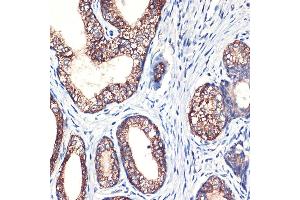 Immunohistochemistry of paraffin-embedded human prostate cancer using Arginase 2 (Arginase 2 ) Rabbit mAb (ABIN7265661) at dilution of 1:100 (40x lens). (ARG2 antibody  (Arg2))
