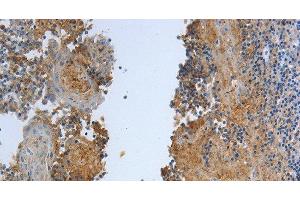 Immunohistochemistry of paraffin-embedded Human tonsil tissue using DLG4 Polyclonal Antibody at dilution 1:30 (DLG4 antibody)