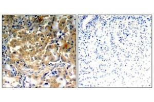 Immunohistochemical analysis of paraffin-embedded human lung carcinoma tissue using PKCζ (Phospho-Thr410) antibody. (PKC zeta antibody  (pThr410))