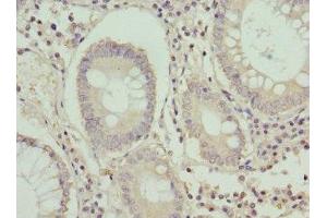 Immunohistochemistry of paraffin-embedded human colon cancer using ABIN7154629 at dilution of 1:100 (K-RAS antibody  (AA 2-168))