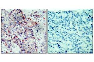 Immunohistochemical analysis of paraffin-embedded human breast carcinoma tissue using SEK1/MKK4(Phospho-Ser80) Antibody(left) or the same antibody preincubated with blocking peptide(right). (MAP2K4 antibody  (pSer80))