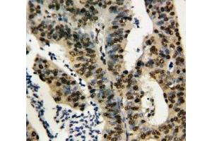 IHC-P: TNFAIP1 antibody testing of human rectal cancer tissue (TNFAIP1 antibody  (N-Term))