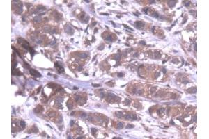Detection of PPP1Ca in Human Breast cancer Tissue using Polyclonal Antibody to Protein Phosphatase 1, Catalytic Subunit Alpha Isoform (PPP1Ca) (PPP1CA antibody  (AA 2-330))