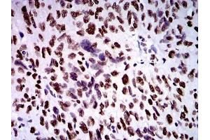 Immunohistochemical analysis of paraffin-embedded ovarian cancer tissues using ZFP91 mouse mAb with DAB staining. (ZFP91 antibody  (AA 162-304))